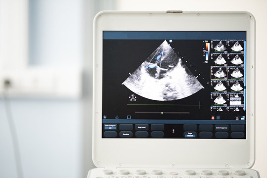 Screen of an ultrasound scanner with the image of tricuspid regurgitation by the Doppler method.