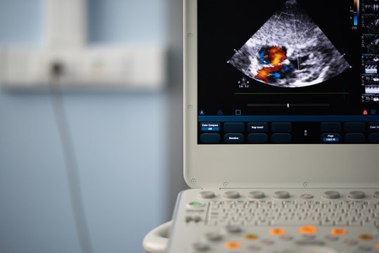 Screen modern ultrasound scanner with the image of interatrial communication.