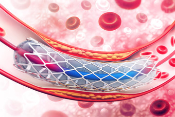 Stent angioplasty. 3d illustration