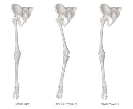 Types disease of lower half limbs or leg bone problem- Normal- Knock knee and Bowlegs or Valgus and Varus knee- 3D medical illustration- human anatomy and educational concept-Isolated white background
