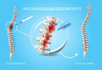 Spine Osteoarthritis Medical Treatment Vector - obrazy, fototapety, plakaty