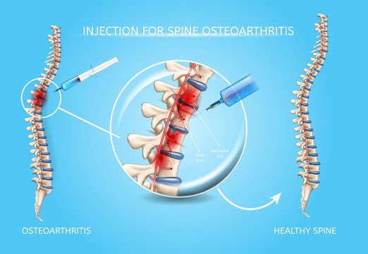 Spine Osteoarthritis Medical Treatment Vector