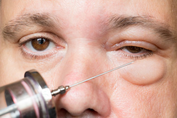 Examination of the sick eye and eyelid in the hospital. Doctor with injection treats the eyes of a...