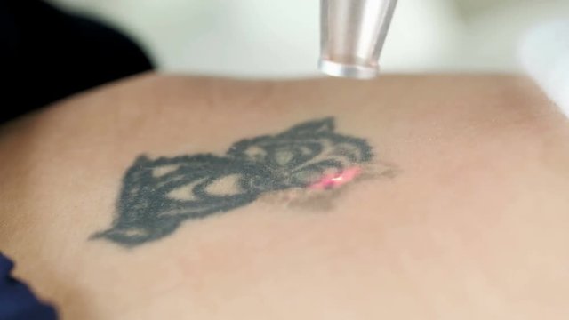 Laser tattoo removal. Beautiful young woman on laser tattoo removal treatment. Close-up view of a laser treatment for a woman in clinic. Doctor in gloves.