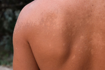 Sunburn on the skin of the back. Exfoliation, skin peels off. Dangerous sun tan