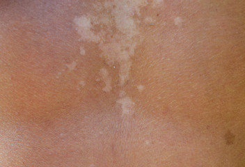 Fototapeta premium Sunburn on the skin of the back. Exfoliation, skin peels off. Dangerous sun tan
