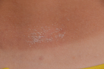 Fototapeta premium Sunburn on the skin of the back. Exfoliation, skin peels off. Dangerous sun tan