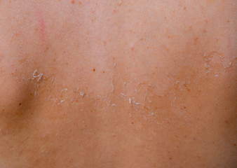 Fototapeta premium Sunburn on the skin of the back. Exfoliation, skin peels off. Dangerous sun tan