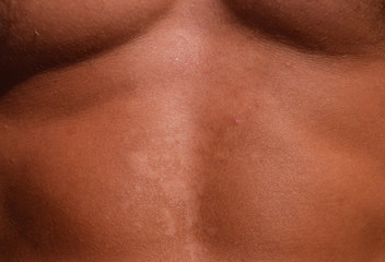 Sunburn on the skin of the stomach. Exfoliation, skin peels off. Dangerous sun tan