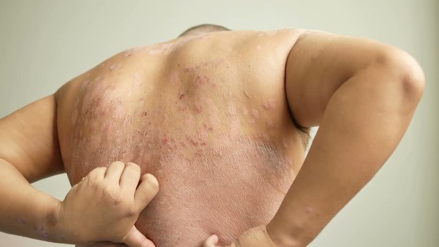 Men is their hands to scratch the wound. Diseases caused by abnormalities of the lymph. Psoriasis is a skin disease.