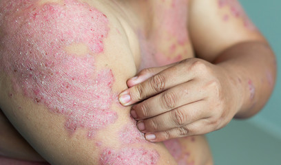 Diseases caused by abnormalities of the lymph