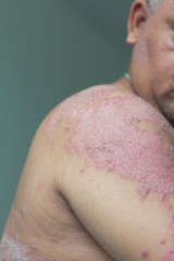 Fototapeta premium Patients look at their own shoulder filled with inflammation