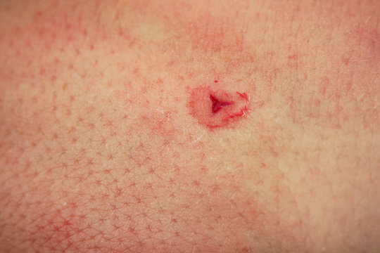 Medicinal Leech - Hirudo medicinalis - leech bite, typical triangle leech bite after sucking blood on the human body