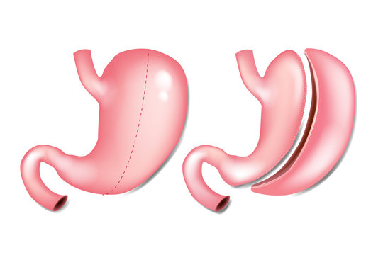 Laparoscopic  Gastrectomy Gastric Sleeve (also known as the Greater Curve Gastrectomy, Vertical Gastrectomy)