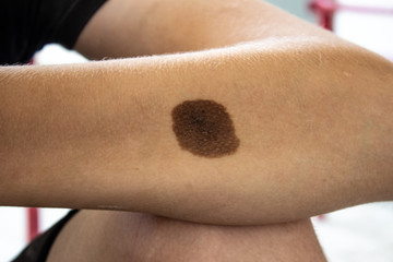 large mole on the skin