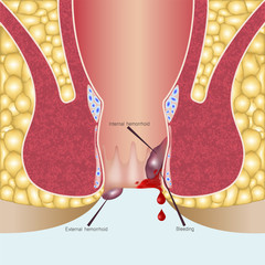 Internal hemorrhoids and external hemorrhoids
