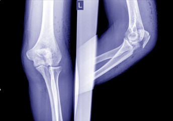 Film elbow AP showed fracture of elbow.