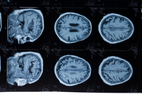 Head MRT. MR image of human brain