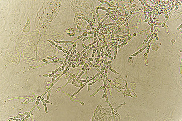 Pseudohyphae and budding yeast cells in patient urine (urinary tract infections), analyze by microscope