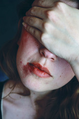 Mujer maltratada con golpes recientes 