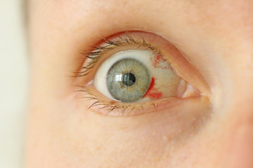 Bloodshot eye. Woman with burst blood vessel in eye. Very red bloody eyeball. Bleeding damage in...