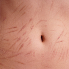 belly with scars and cuts from deliberate self-harm