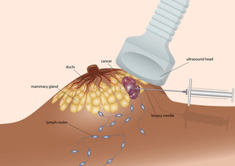 Biopsy the breast cancer cell