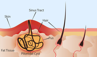 Inflammation in the hair follicle