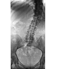 curvature of the spine