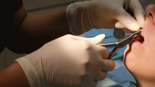 Orthodontist dentist pulls the arc on the bracket system close-up with forceps