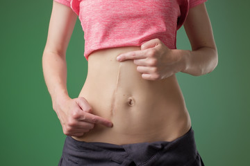Woman with long abdominal scars after operation