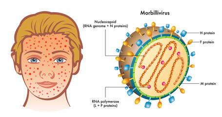 Cutaway labelled diagram of Morbillivirus with illustration of boy showing symptoms on face, white background.