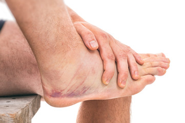 Fototapeta premium Sprained ankle with bruising isolated on white background