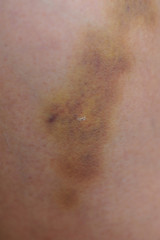 Fototapeta premium domestic violence on leg