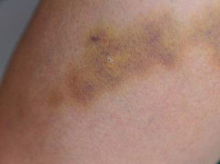 Fototapeta premium domestic violence on leg