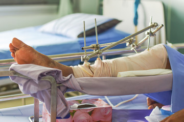 Orthopedic treatment Bone surgery of patients Steel bone