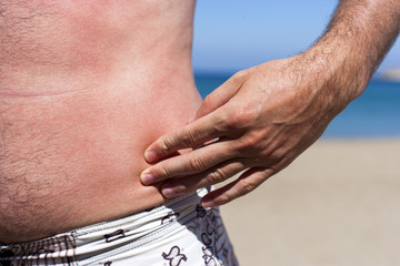 Male body summer vacation sunburn