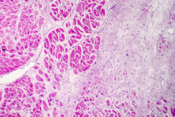 Acute myocardial infarction, histology of heart tissue, light micrograph. Area of infarct is paler...