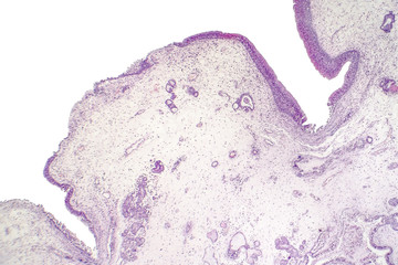 Inflammatory polyp, light micrograph, photo under microscope