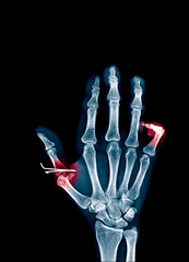 X-ray image of hand and fingers show fracture at Thumb and little finger. Pain concept