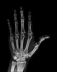 X-ray image of normal Hand , xray medical background.