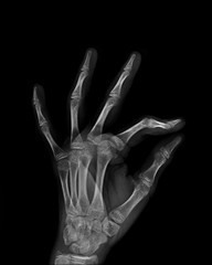 X-ray image of normal Hand , xray medical background.