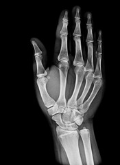 X-ray image of normal Hand , xray medical background.