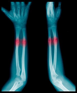 X-ray image of Forearm bone fracture in child's (Radius bone, Ulna bone)