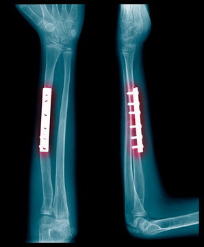 Fracture bones of forearm. Orthopedic surgeon operated and internal fixed with plate and screw (after operation)