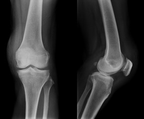 X-ray image of normal old age Knee