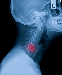 X-ray of neck and cervical spine side view. Image of radiography from patient who have neck pain, nerve root compression, numbness at arm hand wrist or finger
