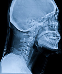 X-ray of neck and cervical spine side view. Image of radiography from patient who have neck pain,...