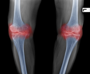 Xray image of senior woman knee pain show osteoarthritis both knee joint. Knee swelling and...
