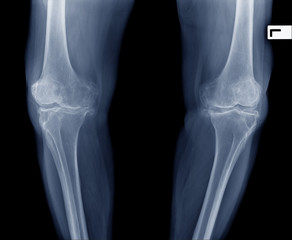 Xray image of senior woman knee pain show osteoarthritis both knee joint. Knee swelling and...